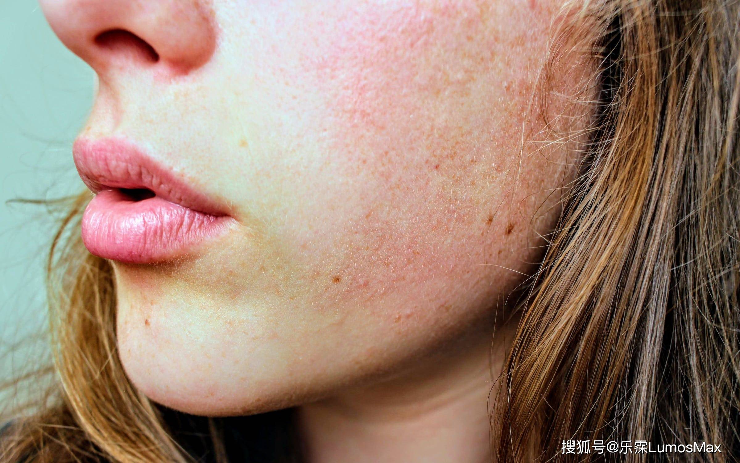 春季如何预防皮肤过敏记住这3条就够了