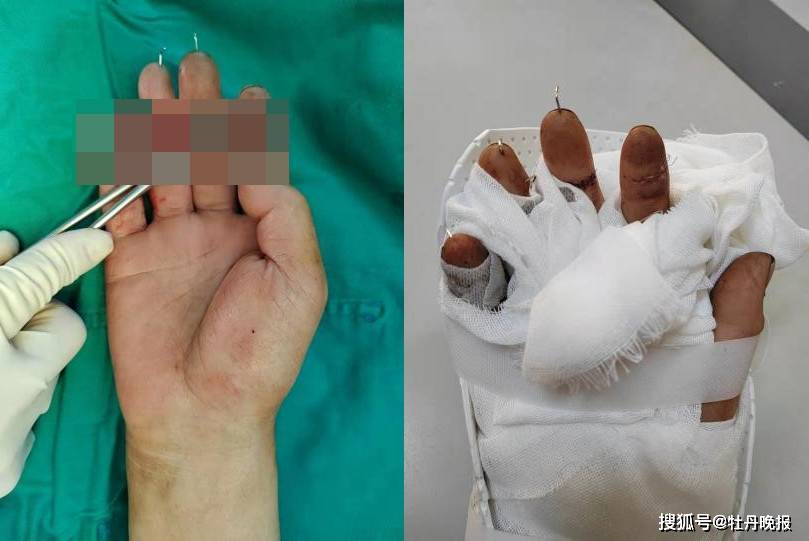 马金朋_手术_动静脉