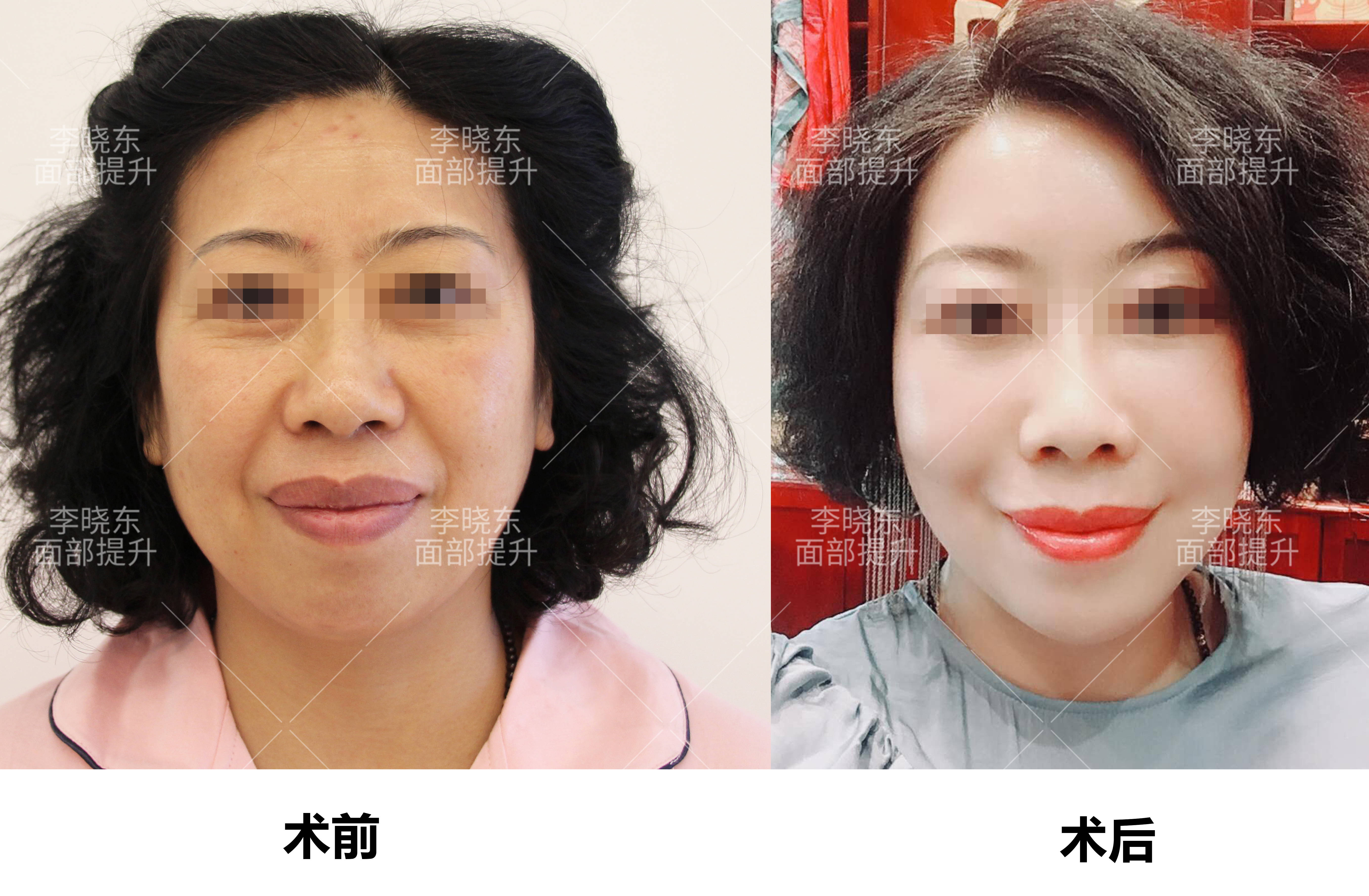 章女士谁说我们不能年轻：章女士，面部提升60天的华丽转变