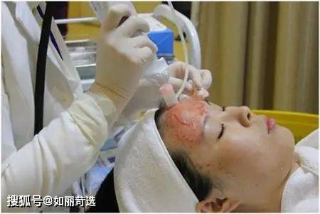 治疗深扒网红轻医美光子嫩肤的王炸cp指南，花1K做5K的效果！这份攻略速记保存！