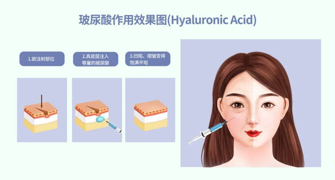弹性涨点医美知识 | 玻尿酸为什么被称为医美“万金油”？