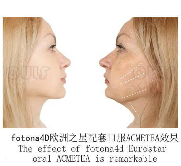 治疗欧洲之星做完多久有效果,隔壁阿姨一把年纪还那么爱美