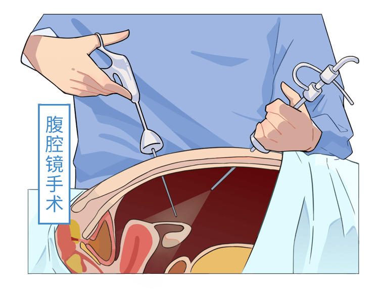 男性結紮和女性結紮哪個傷害更大結紮會降低性能力早知道早受益