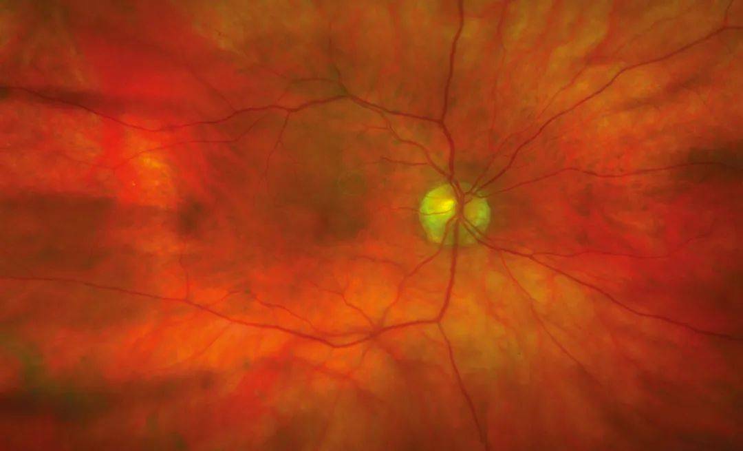 飞蚊症有治了武汉协和医院正式开展激光玻璃体消融术