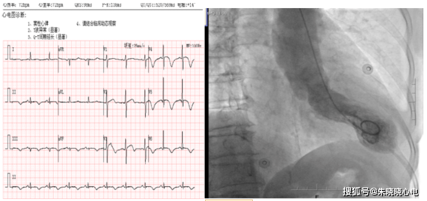造影|3例胸痛、3份ST段抬高心电图，却是3个不同诊断！