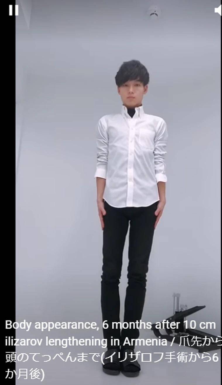 进行167身高太矮！日本男子忍痛进行“断腿手术”成功变身177帅哥