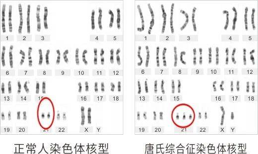 这个由染色体超载引起的先天缺陷虽不可治但可预防