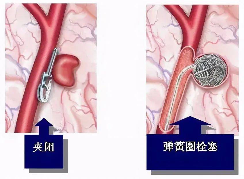 支架|发现颅内“炸弹” 神外医生巧用小小弹簧圈拆除引信