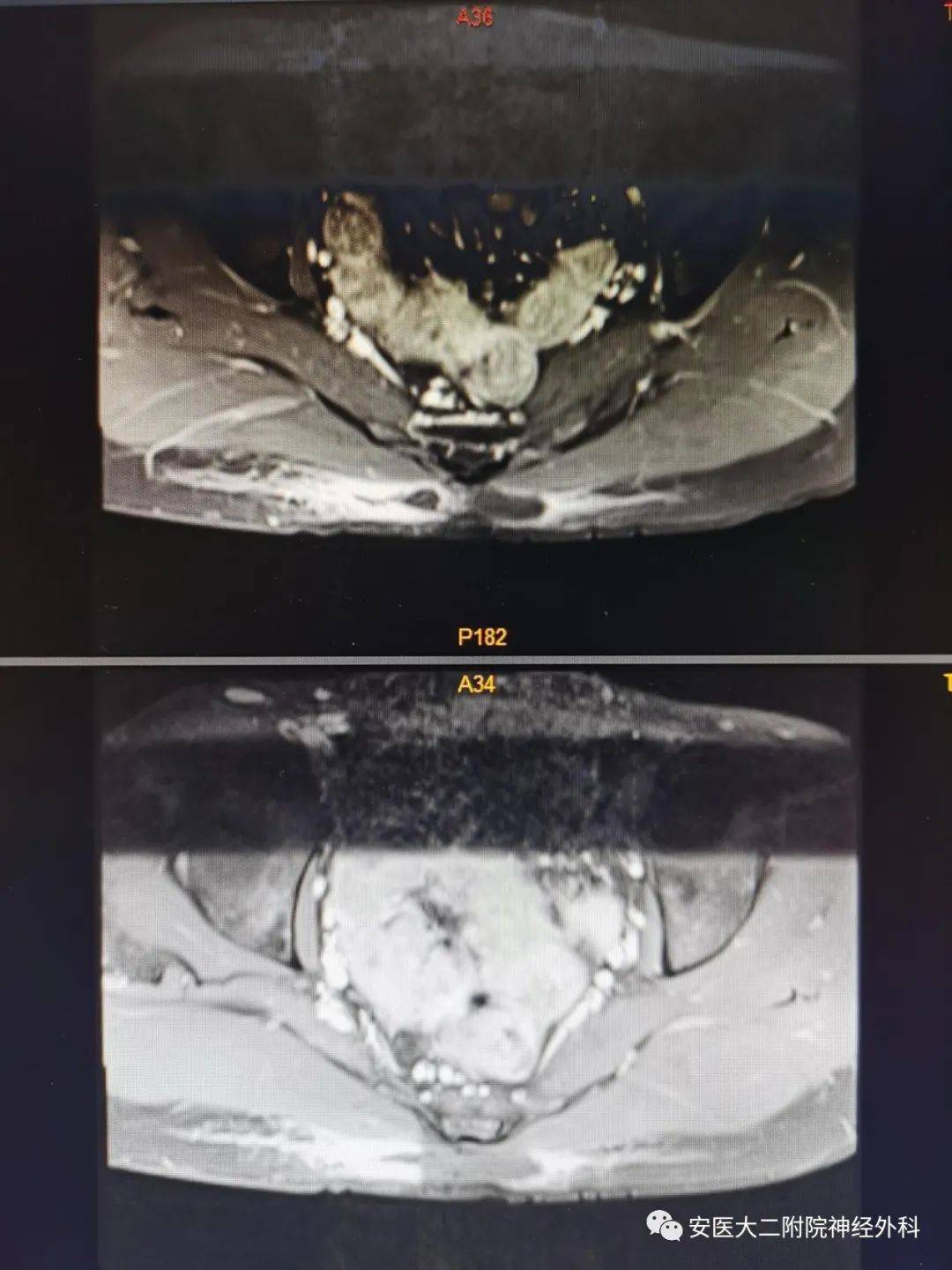 赵兵|MDT模式下完成骶尾部巨大表皮样囊肿手术切除一例