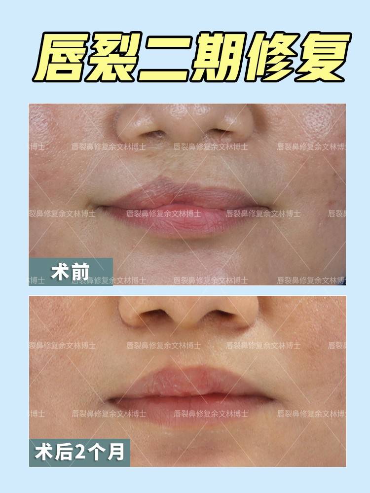 术后2个月恢复良好,上唇形态佳,红唇对称,饱满,唇红缘基本对称,两侧鼻