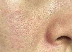 黑头想要做到0毛孔0黑头，你需要这么做！