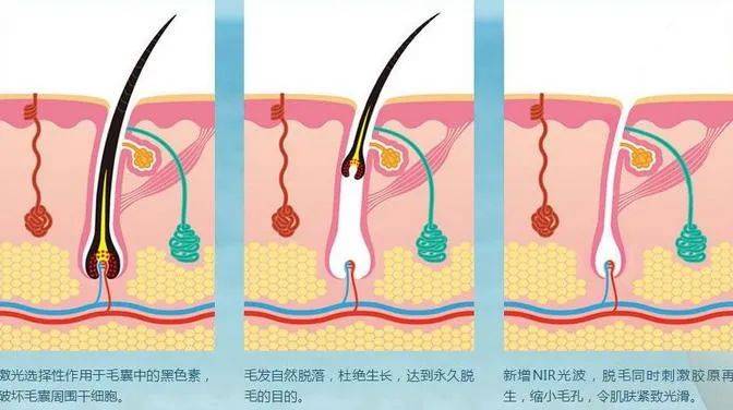 方法常见的脱毛方法有哪些