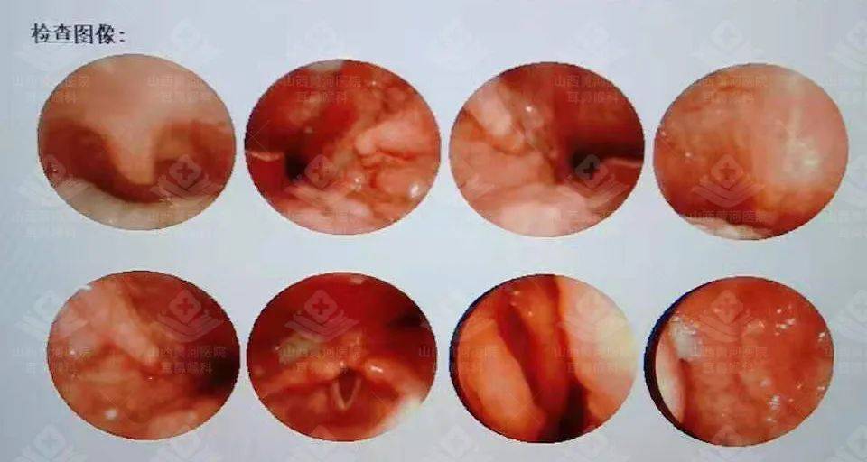 舌根淋巴癌图片