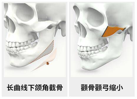 手术联合丽格何照华教授：颧骨颧弓和下颌角手术可以一起做吗？