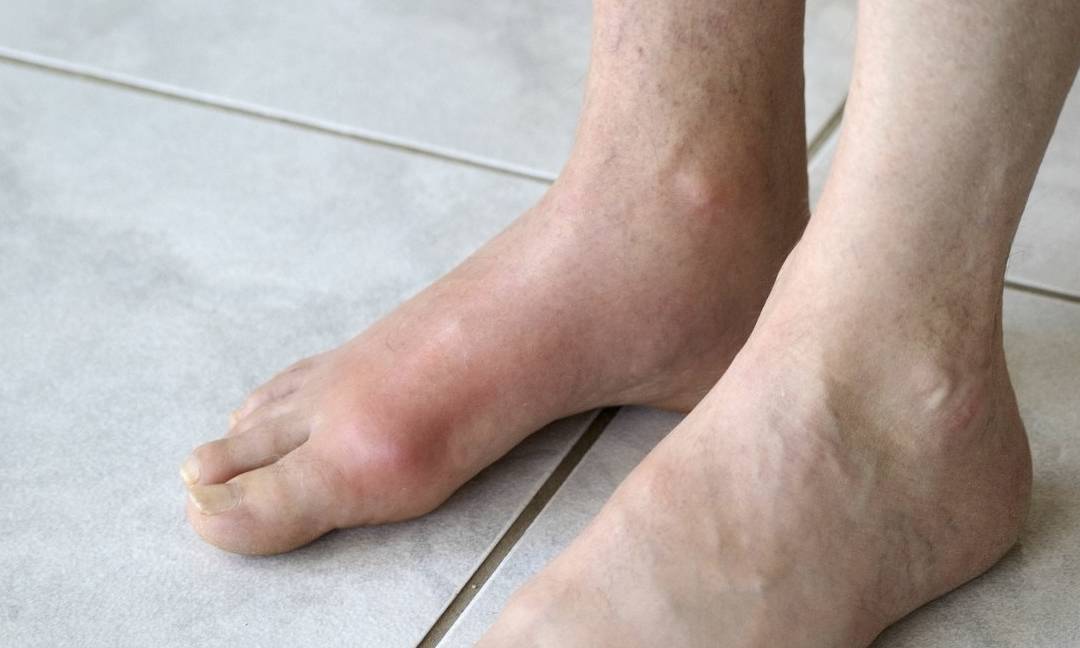 原创山东一男子因尿酸高入院原因或许是平时没注意痛风加速器