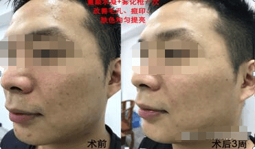 什么小伙伴们、PLLA膜是什么、为什么那么多名媛是它的脑残粉～