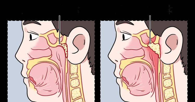 扁桃体,腺样体肥大也会引发张口呼吸如果脂肪过多,导致气管狭窄气管和