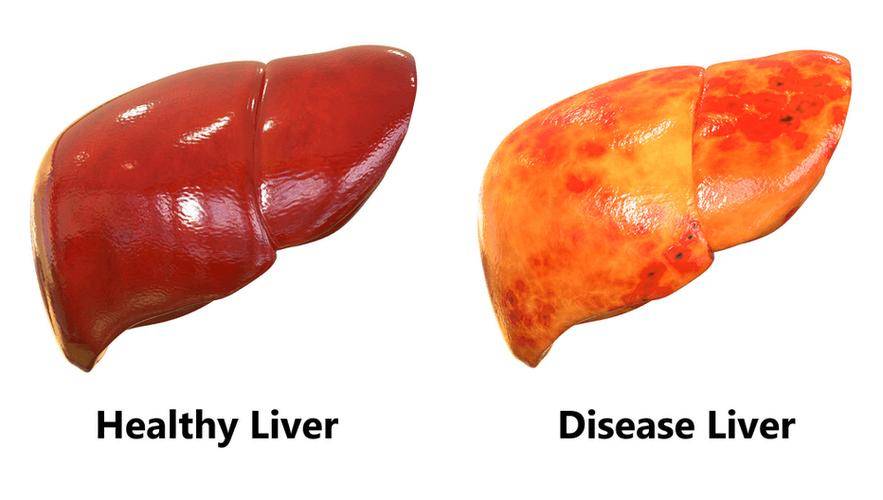 肝脏有癌，身体先知！身体若存5个“异常”，早发现早治疗