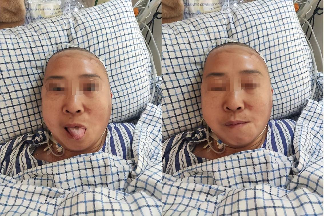 「13小时手术」切除巨大听神经瘤,完好保留面神经功能_肿瘤_患者_症状