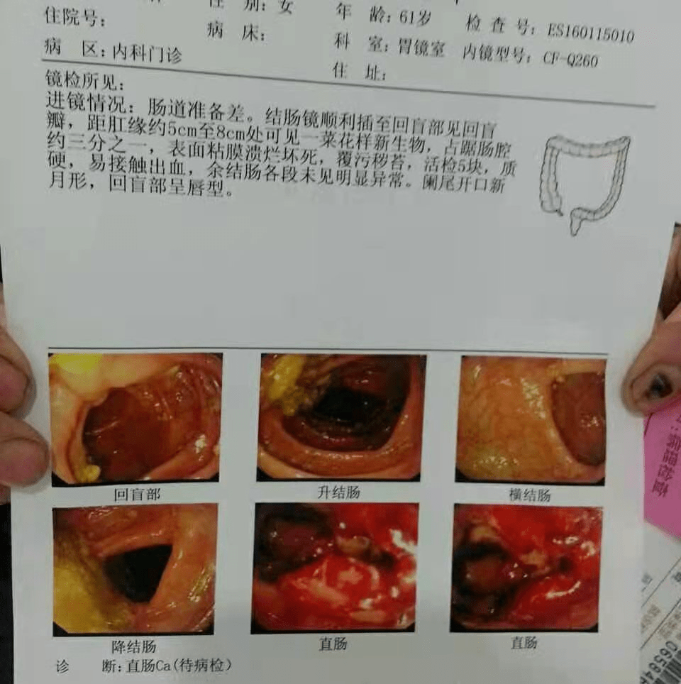 肠癌报告单图片图片