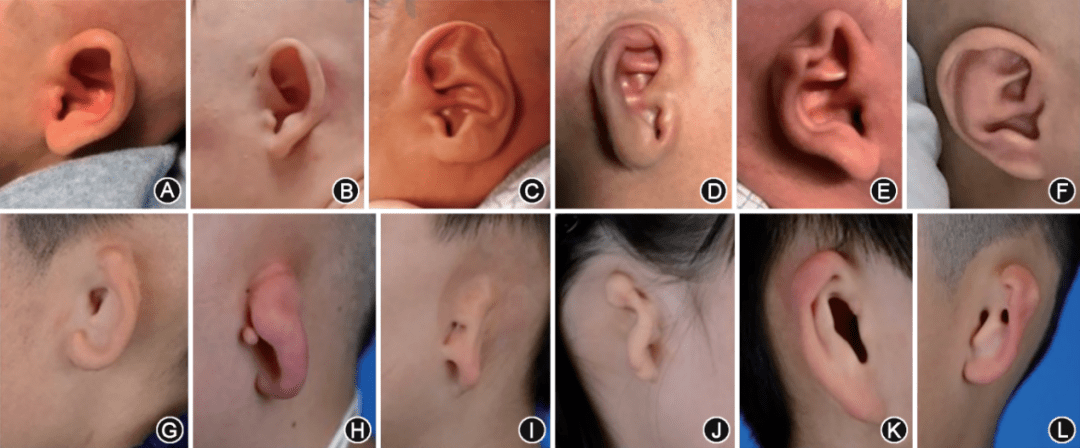 耳廓畸形耳模无创矫正