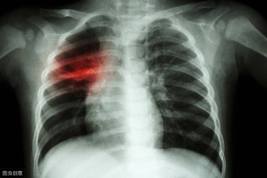 43岁男子胸闷查出肺癌！医生：早起有这3种表现，多半是肺癌