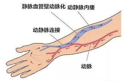 动静脉内瘘成形术图解图片