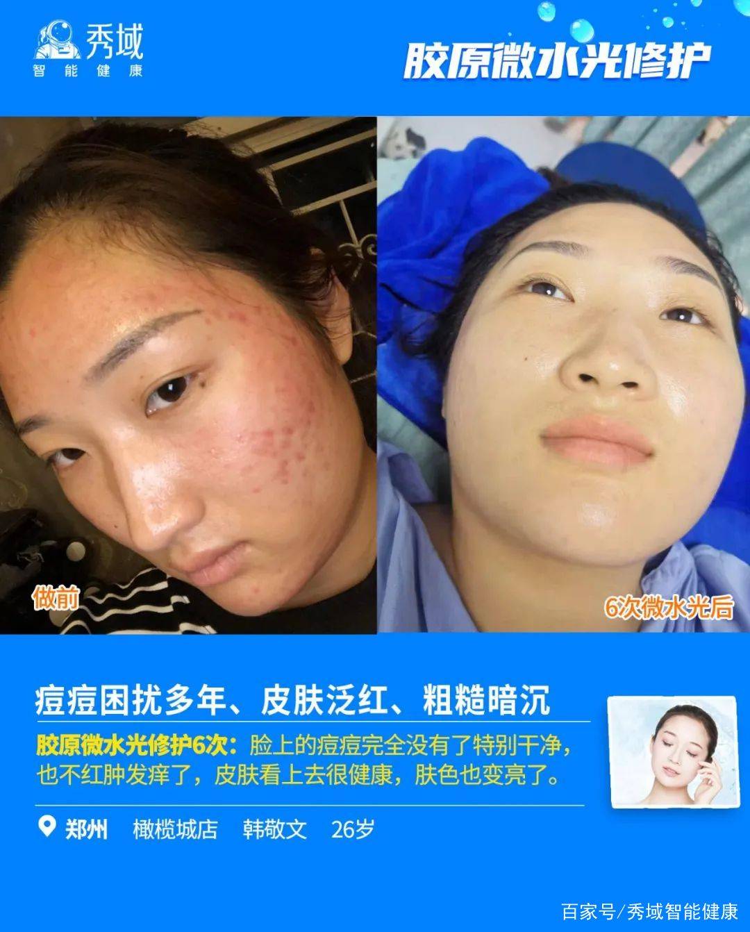 让肌肤焕然一新基因科技物理材料科技生物科技强强联合拯救痘痘肌