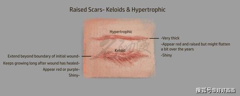 当在伤口部位产生过多的胶原蛋白时,就会在皮肤上方出现凸起的疤痕