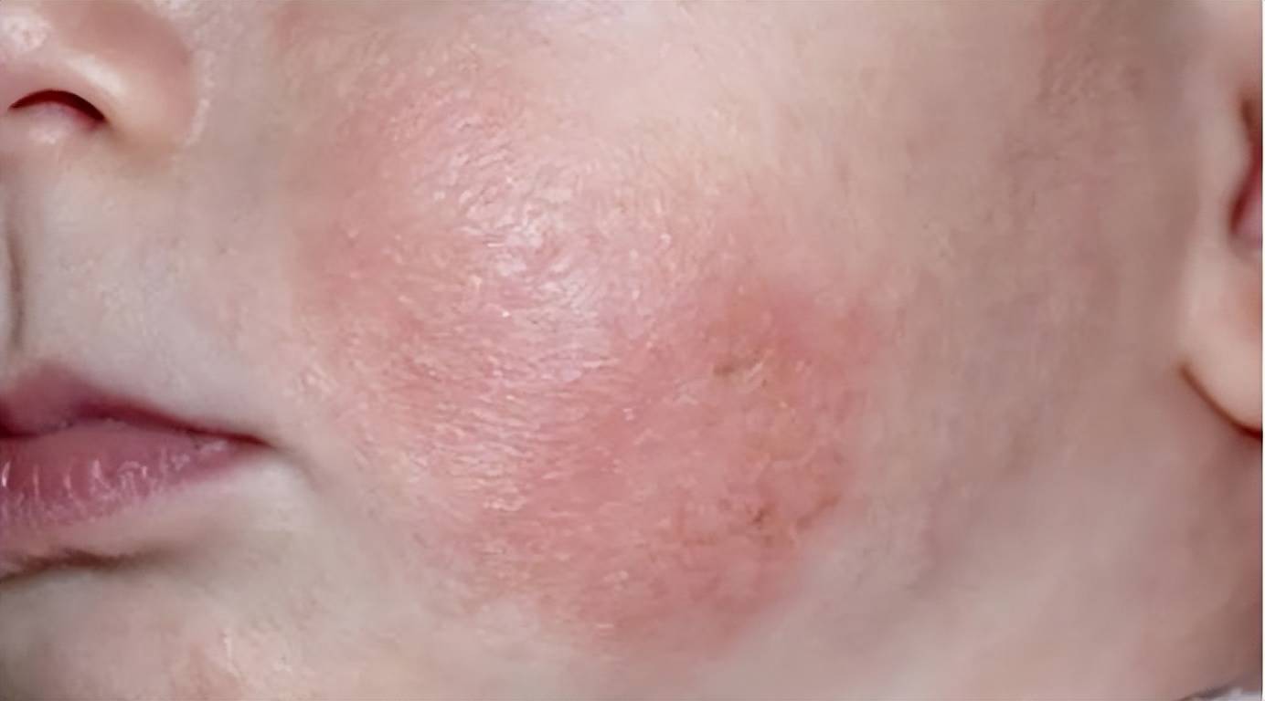 湿疹分为急性期,亚急性期,慢性期,不同的时期皮损不同,治疗和护理的