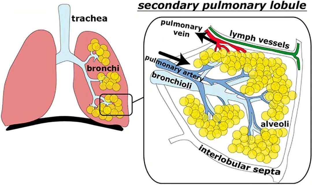 小葉間隔呈黑色學習間質性肺疾病必須掌握次級肺小葉的正常解剖