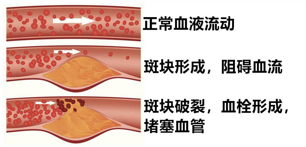 血管硬化,身体常有哪些表现?会出现心梗,脑梗吗?吃什么好?