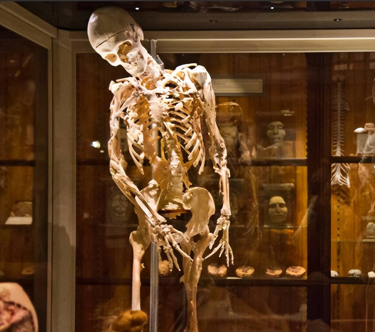 原创爆炸性增生骨骼的怪病他们不惜死后展出自己的骨架