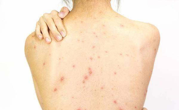 原创体内是否有湿气这6个症状帮你判断占两个以上该祛湿了