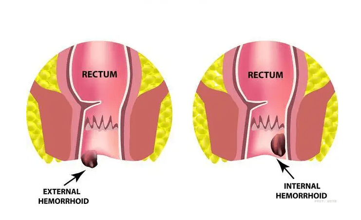 肛门外痔肉球怎么消除?有痔青年的肉球消除体验日记