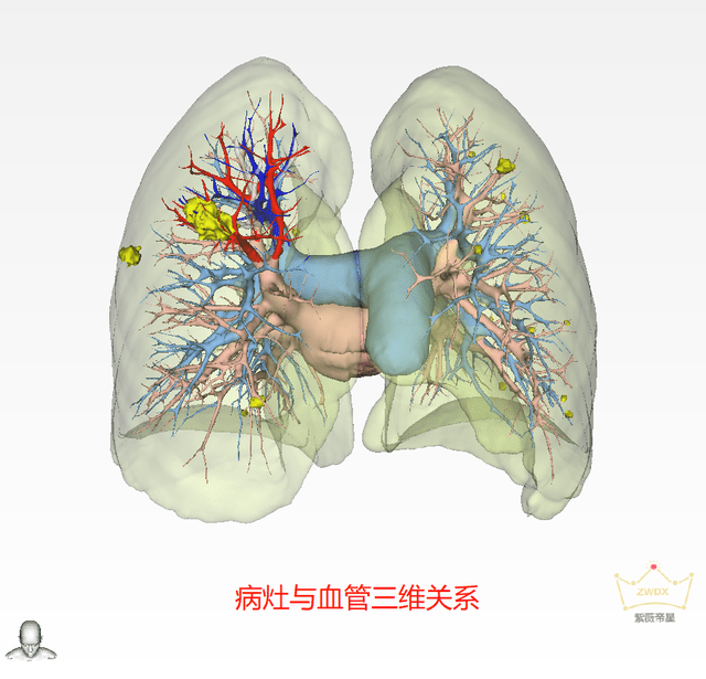 南京大学医学院附属鼓楼医院运用三维重建技术成功开展一例右上肺腺癌