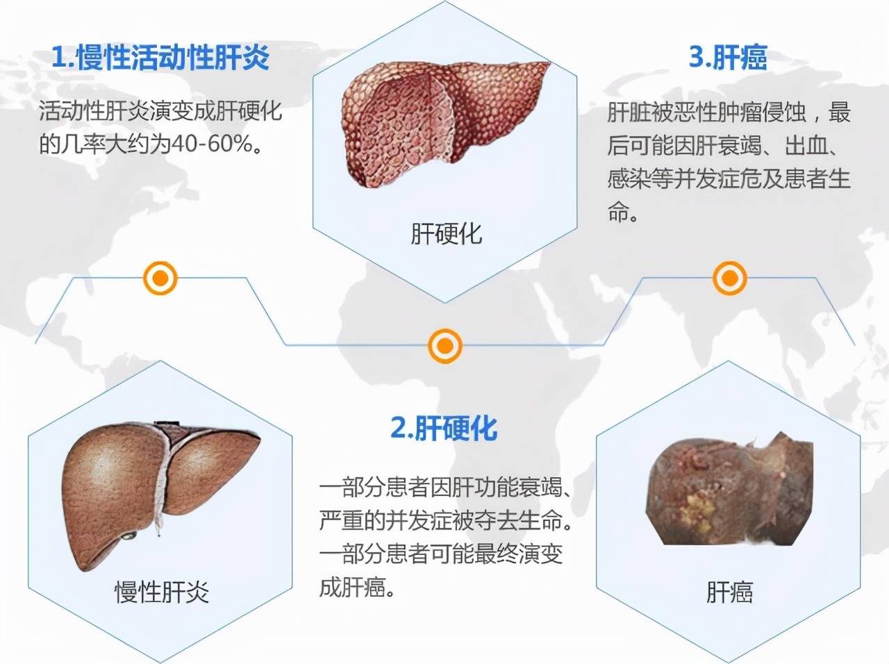 乙肝肝硬化肝癌是肝炎患者的必然宿命嗎4個堅持很關鍵