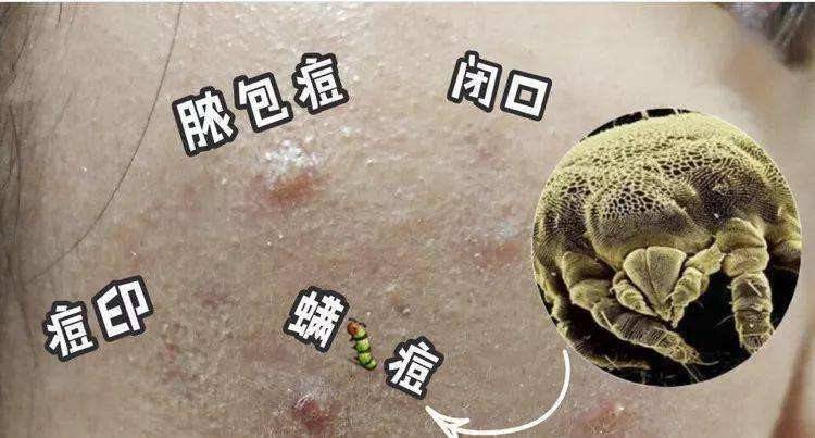 导致脸上坑坑洼洼非常难看;而且螨虫还会寄生在毛囊和皮脂腺上,引发
