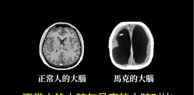 马克_约翰·罗博_大脑