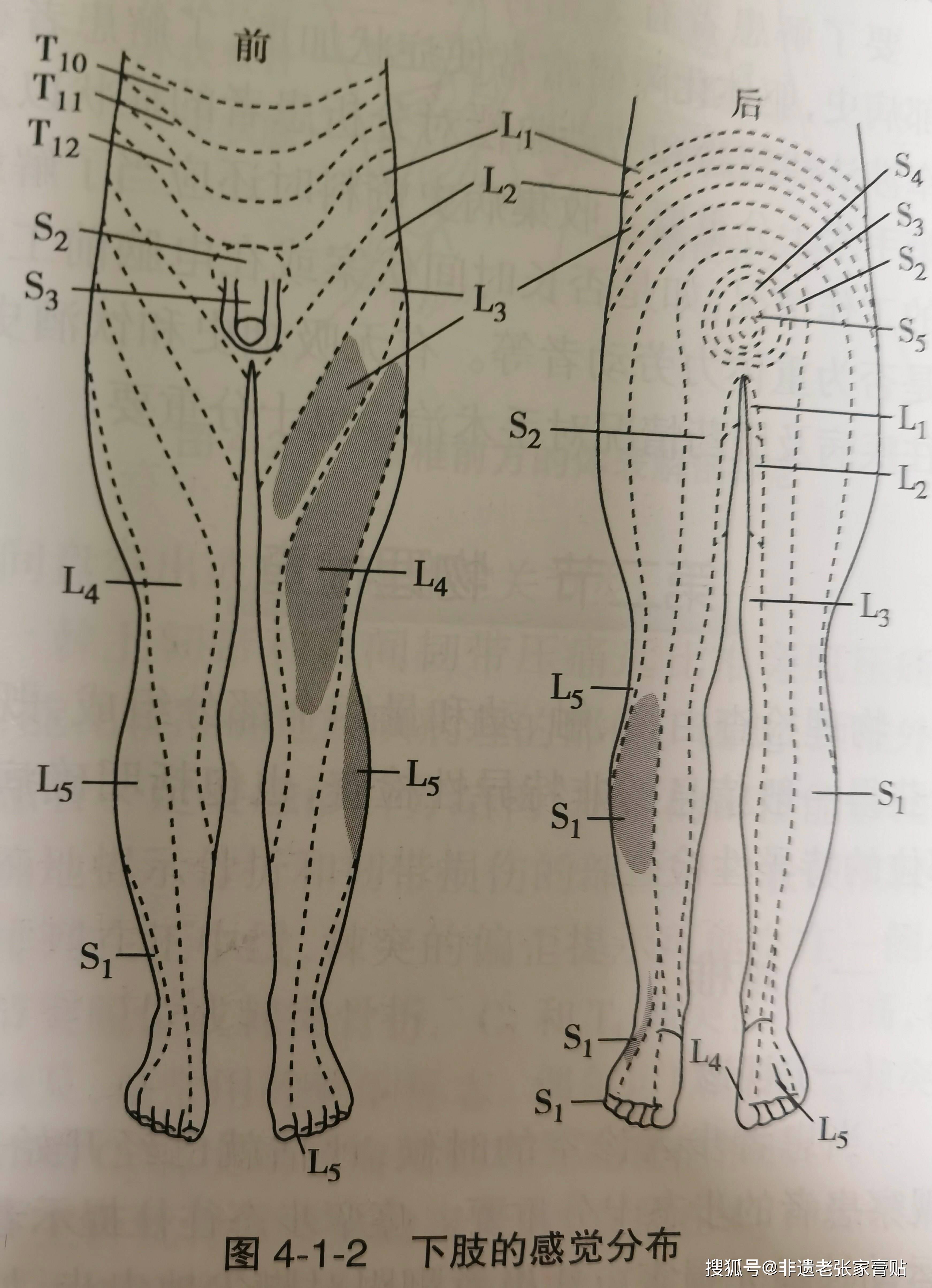 站立時不能直腰,腰彎向一側,走路跛行,在床上不能翻身,但如果側臥屈膝