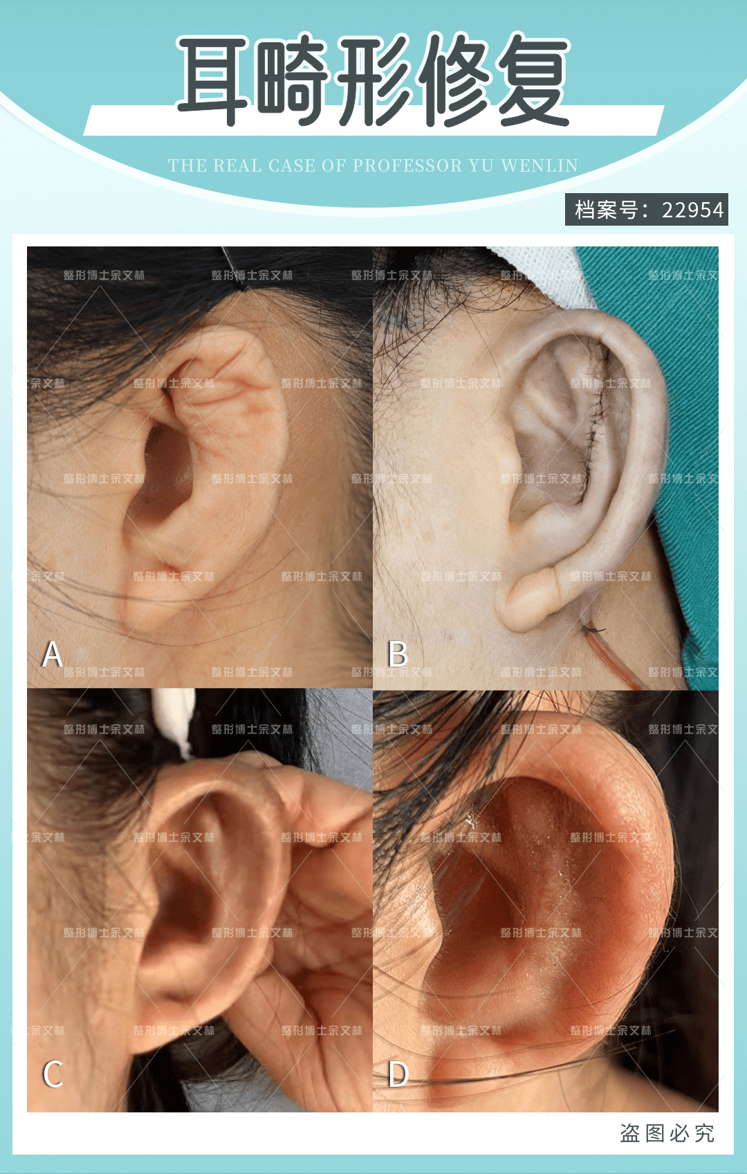案例分析小姐姐的左边耳软骨取太多了现在左耳缩成小小一个