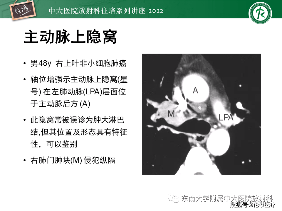 放射科住培講座心包隱窩的ct解剖及在腫瘤影像檢查中的臨床意義