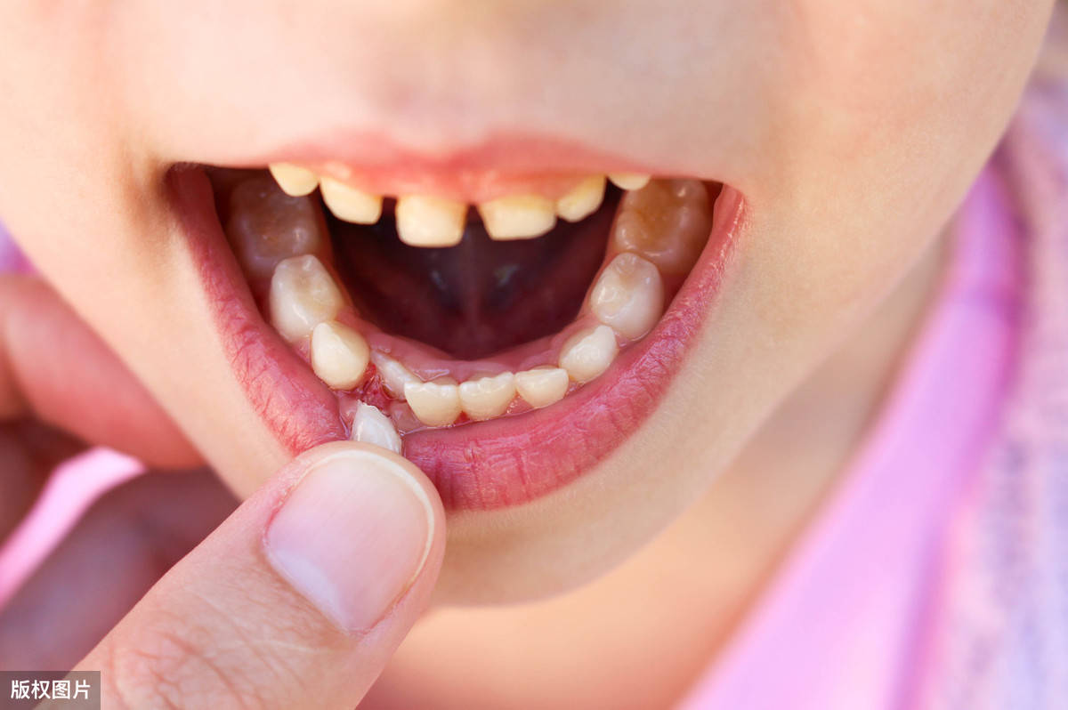 迷死氧兼职看牙 | 杨天宝的整牙论，大概是长了12对智齿吧 - 知乎