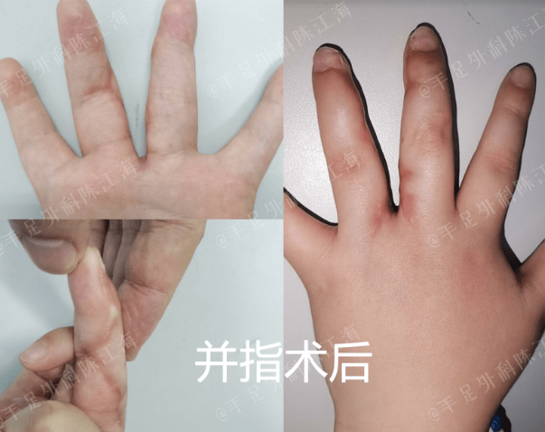 孩子手指并在一起分指要在身上取皮植皮有没有免植皮的方法