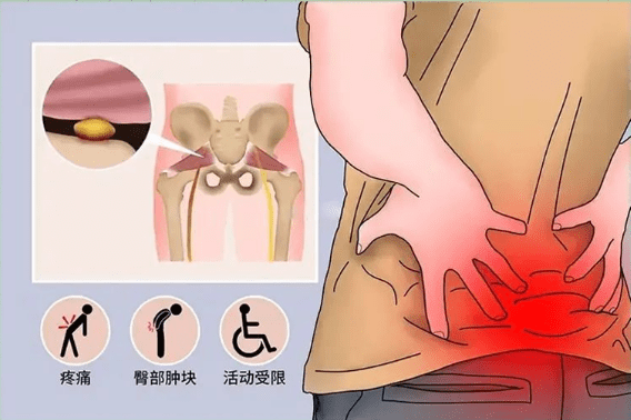 梨状肌梨状肌是臀部一块深层肌肉,主要功能是支撑下肢运动,臀部旋转