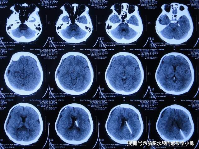 车祸脑外伤开颅术后间断发热近4个月持续加重颅内感染致昏迷双腿瘫痪