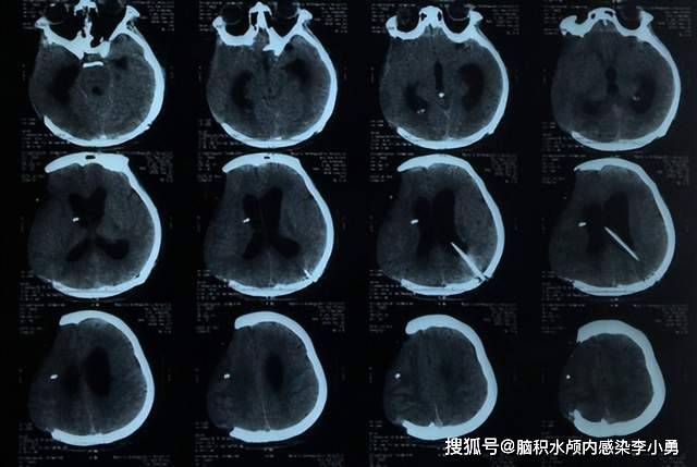 入院後繼續行腦室外引流,每日約引流黃色渾濁腦脊液約300ml左右.