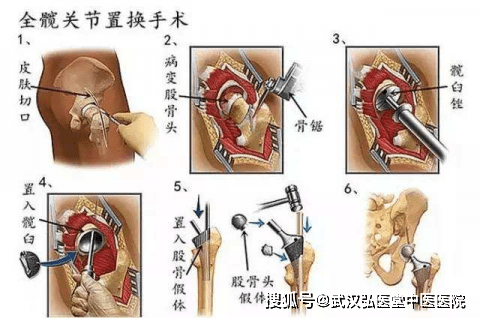 股骨头坏死保髋还是置换选错了吃大亏