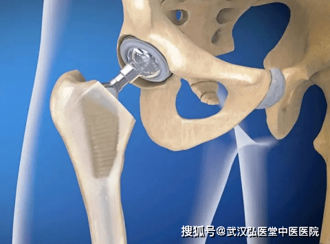 股骨头坏死"保髋"还是"置换",选错了吃大亏!