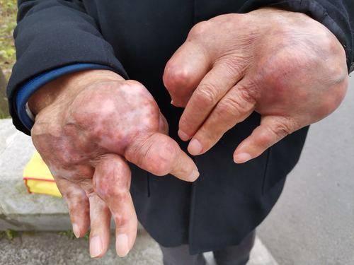 提醒:3种方法可远离痛风_尿酸_果糖_患上